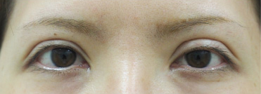 症例25　他院眼瞼下垂術後 手術前