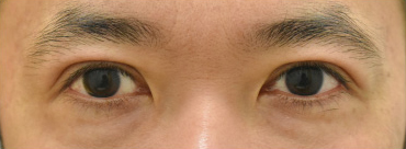 症例38　他院眼瞼下垂術+二重切開法術後 手術前