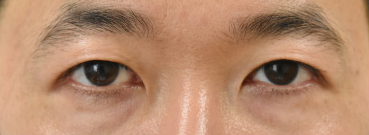 症例38　他院眼瞼下垂術+二重切開法術後 手術後