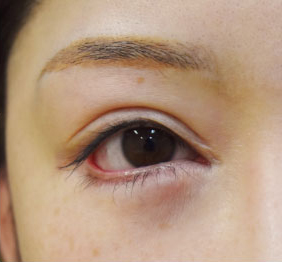 症例10　他院下眼瞼下制術後 手術前