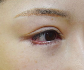 症例10　他院下眼瞼下制術後 手術前