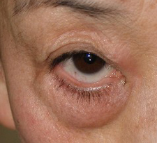 症例1　他院下眼瞼除皺術後 手術前
