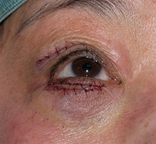 症例1　他院下眼瞼除皺術後 手術直後