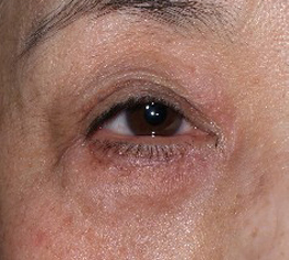 症例1　他院下眼瞼除皺術後 手術１ヶ月後