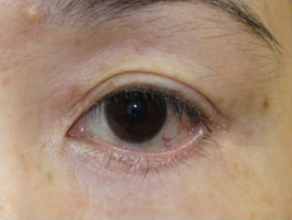 症例2　他院下眼瞼除皺術後 手術前