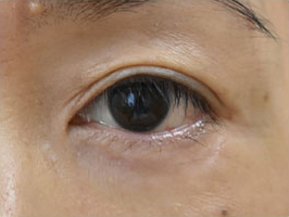症例2　他院下眼瞼除皺術後 手術後
