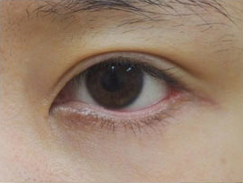 症例3　他院下眼瞼下制術後 手術前