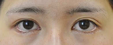 症例4　他院下眼瞼下制術後 手術前