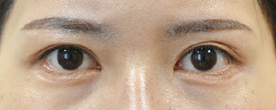 症例4　他院下眼瞼下制術後 手術後