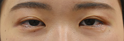症例5　他院下眼瞼下制術後 手術後