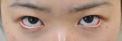 症例5　他院下眼瞼下制術後 手術前
