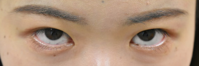 症例5　他院下眼瞼下制術後 手術後