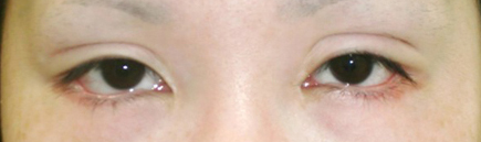 症例6　他院下眼瞼下制術後 手術前