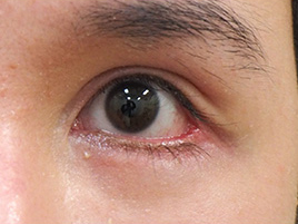 症例7　他院下眼瞼下制術後 手術前