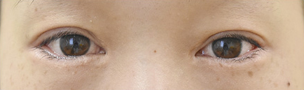 症例8　他院下眼瞼下制術後 手術前
