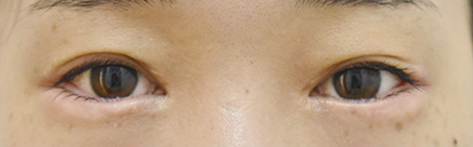 症例8　他院下眼瞼下制術後 手術後