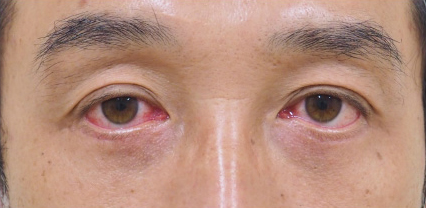 症例9　他院下眼瞼除皺術後 手術前