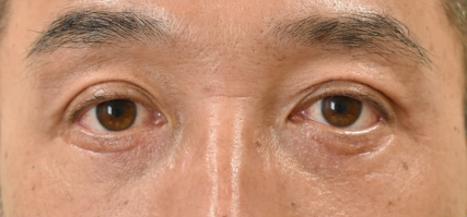 症例9　他院下眼瞼除皺術後 手術後
