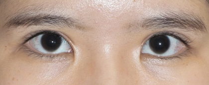 症例6　二重切開法、眼瞼下垂の他院修正 手術後