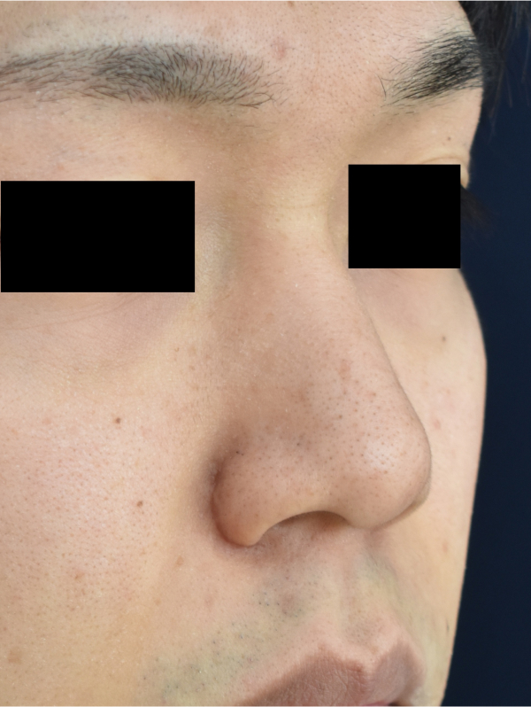 症例3　⿐柱形成・延⻑術（⽿介軟⾻移植）・⼩⿐縮⼩術 手術後2