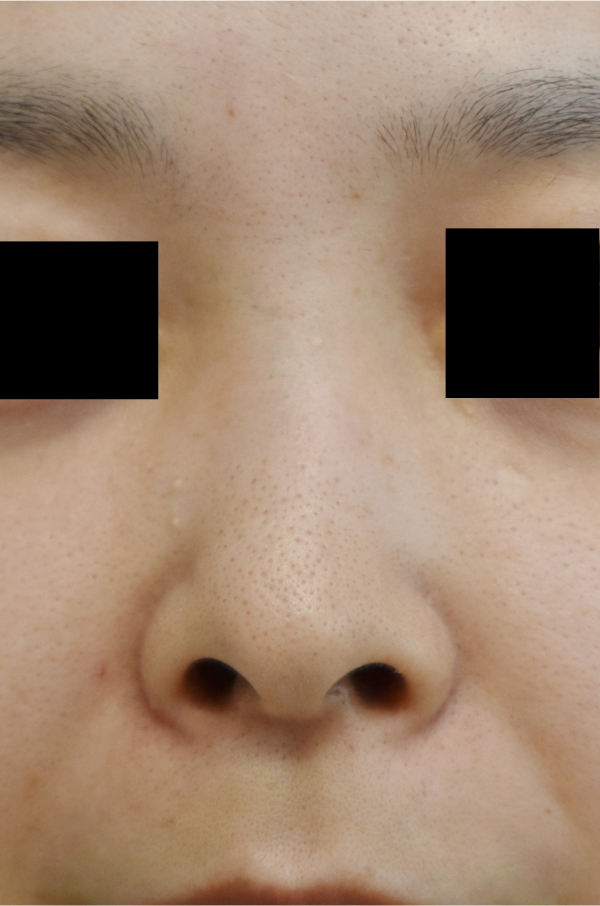 症例4　⿐柱形成・延⻑術（⽿介軟⾻移植）・小鼻縮小術 手術前