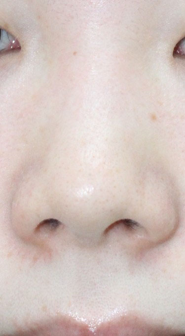 症例3　⿐尖縮⼩術・⿐尖形成術（⽿介軟⾻移植）・⿐柱形成・延⻑術（⽿介軟⾻移植） 手術前
