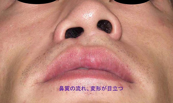 症例6　 鼻翼変形（口唇裂術後）修正手術 手術前