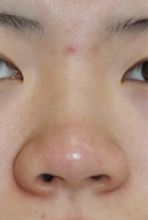 症例10　鼻柱形成術（耳介軟骨移植）・鼻翼縮小術 手術前