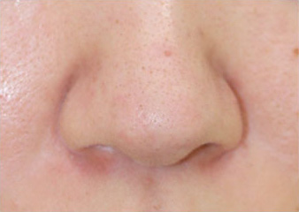 症例14　鼻尖縮小術 手術前