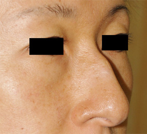 症例15　整鼻術（鼻骨削り） 手術前