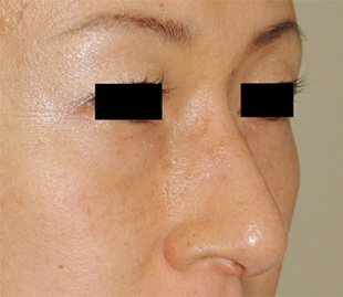 症例15　整鼻術（鼻骨削り） 手術後
