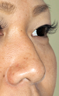 症例2　隆鼻術（ヒアルロン酸） 施術前