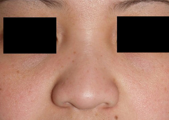 症例5　隆鼻術 手術前
