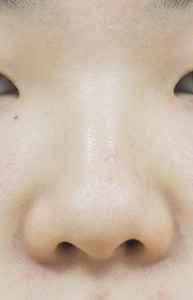 症例8　隆鼻術・鼻翼縮小術 施術前