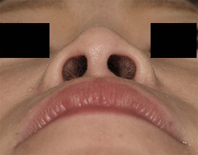症例9　隆鼻術・鼻翼縮小術 手術後