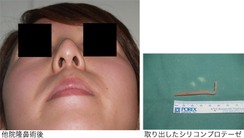 他院での不適切な隆鼻術後の症例・画像