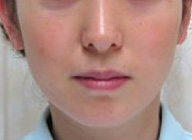 症例1　ウルトラセルQプラス（ドットおよびリニア4.5）　頬全体・あご 施術後