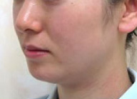 症例1　ウルトラセルQプラス（ドットおよびリニア4.5）　頬全体・あご 施術前