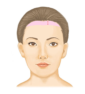 小顔効果・面長の改善 皮膚の切除量 1.5～2.5㎝