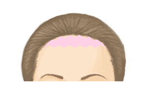 【Before】W形成術