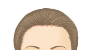 【After】