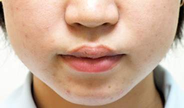 症例2　ヒアルロン酸注射（あご） 施術前