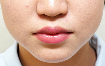 症例2　ヒアルロン酸注射（あご） 施術後