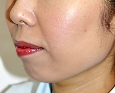 症例3　ヒアルロン酸注射（あご） 治療前