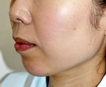 症例3　ヒアルロン酸注射（あご） 治療後