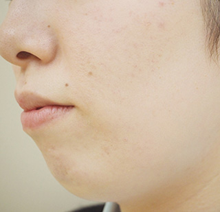 症例4　ヒアルロン酸注射（あご） 治療前