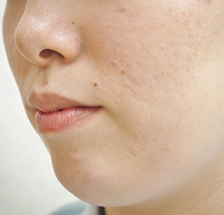 症例4　ヒアルロン酸注射（あご） 治療後