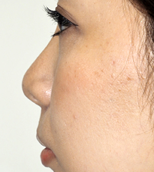 症例1　鼻ヒアルロン酸（隆鼻） 施術前