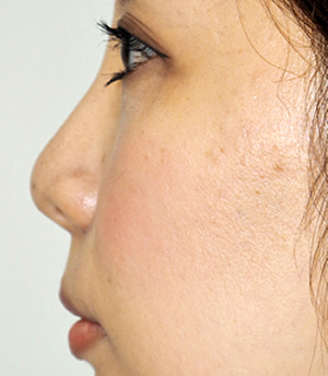 症例1　鼻ヒアルロン酸（隆鼻） 施術後