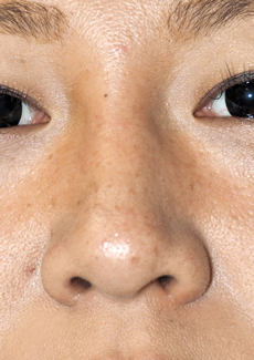 症例2　鼻ヒアルロン酸（隆鼻） 施術後